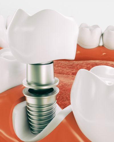 Dental implant