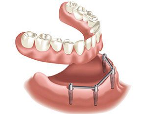 dental implant