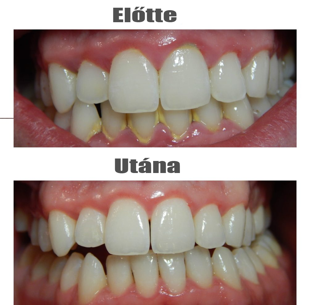 fogkőeltávolítás