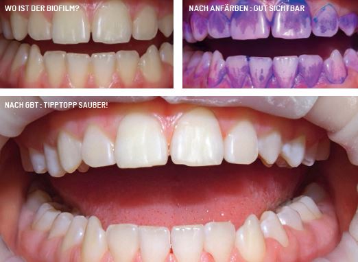 wo ist der biofilm