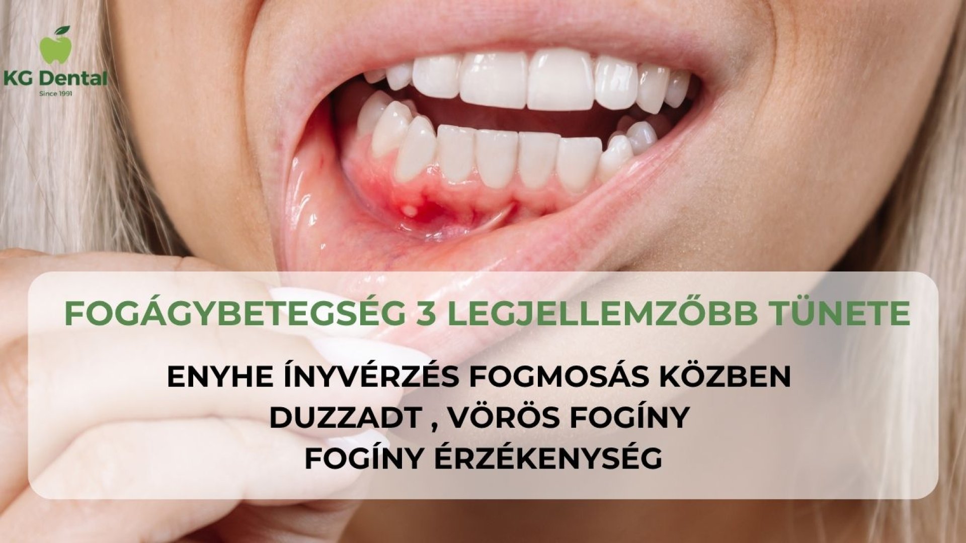 Fogínygyulladás tünetei és kezelése | KG Dental Milyen betegségekkel hozható összefüggésbe a fogínygyulladás?