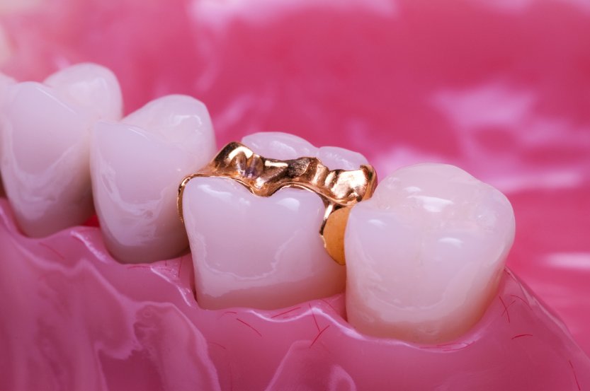 inlay gold inlay