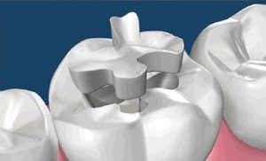 ästhetischen Füllung