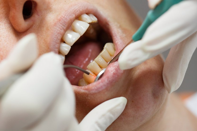 fogászati lézeres kezelés