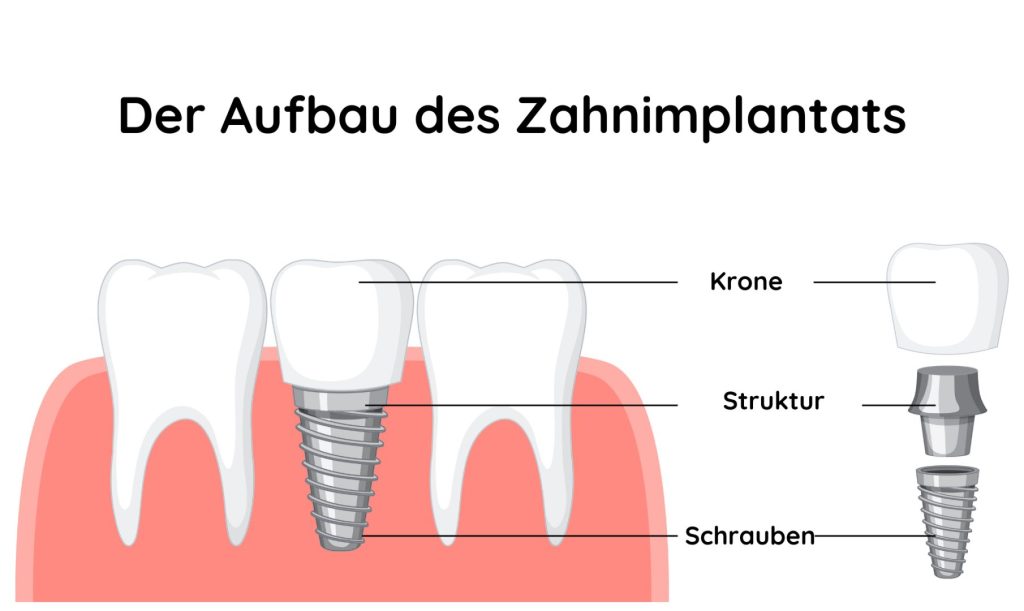 Grafik zur Veranschaulichung des Aufbaus eines Zahnimplantats.