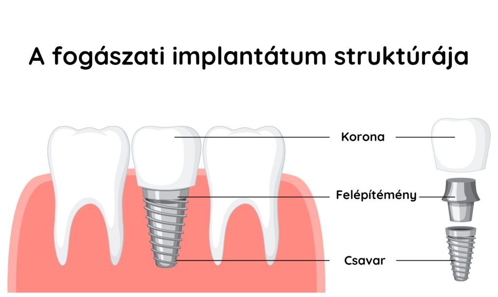 Grafika a fogászati implantátum struktúrájának bemutatására.