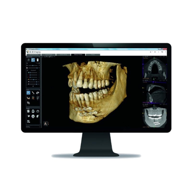 3D CT felvétel egy monitoron.
