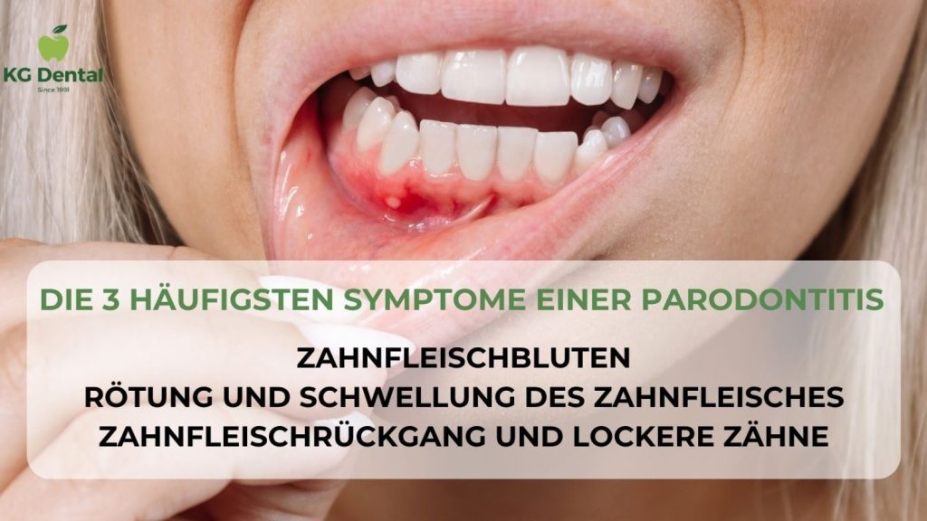 Bei einer Patientin wird eine Gingivitis festgestellt.