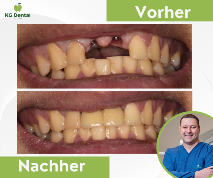 Unvollständige Prothese vor und nach der Zahnbehandlung mit dem Foto von Dr Zoltán Veres.