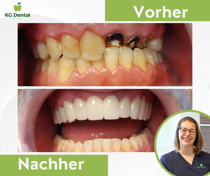 Unvollständige Prothese vor und nach der Zahnbehandlung mit einem Foto von Dr Mirtil Bertalan.