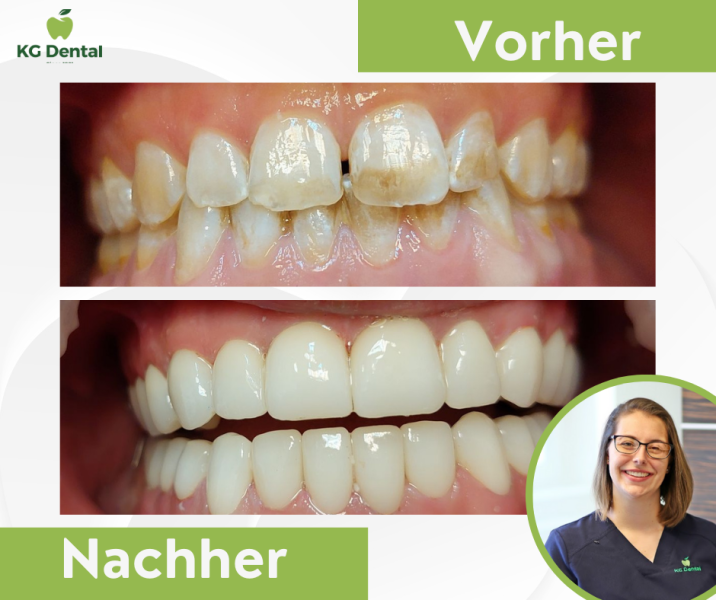 Verfärbte Zahnprothesen vor und nach der Zahnbehandlung mit einem Foto von Dr Mirtil Bertalan