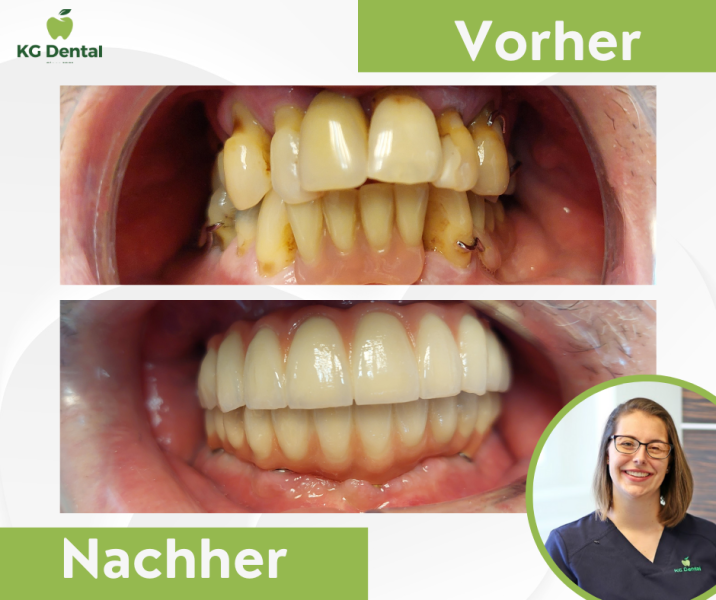 Vorher-nachher-Bild der Zahnbehandlung Foto von Dr Bertalan Mirtil.