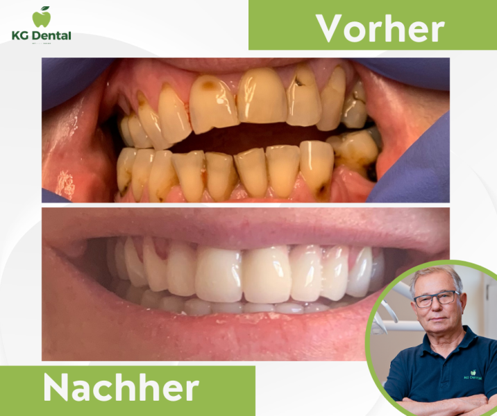 Vorher-nachher-Bild der Zahnbehandlung Foto von Dr. Tibor Koltai.