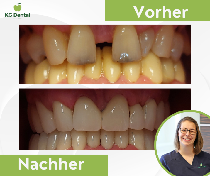 Vorher und nachher​Zahnbehandlung Schließung einer Zahnlücke Fotos von Dr Bertalan Mirtil.