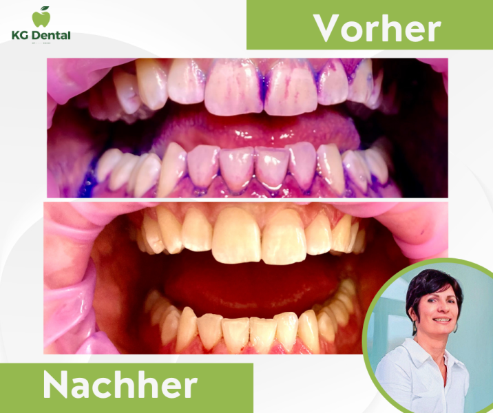 Zahnprothese vor und nach der Zahnreinigung mit dem Foto von Kondor Orsolya.