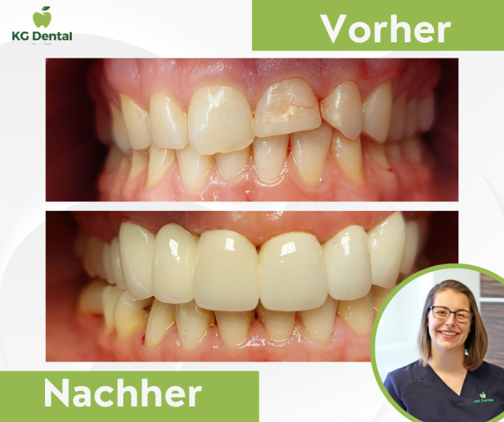 Zahnprothesen mit abgebrochenen Zähnen vor und nach der Zahnbehandlung mit einem Foto von Dr Mirtil Bertalan.