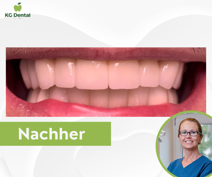 Zahnprothesen nach einer Zahnbehandlung mit dem Foto von Dr Krisztina Szabó.