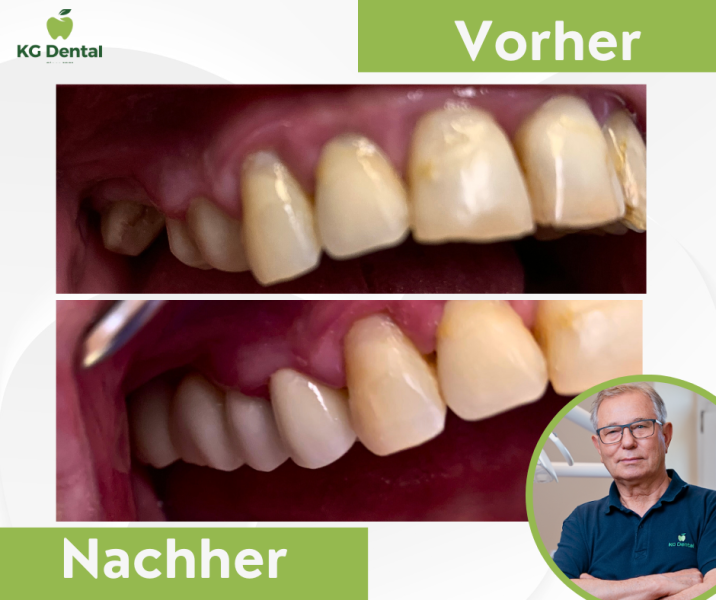 Zahnprothesen von der Seite vor und nach der Zahnbehandlung mit einem Foto von Dr Tibor Koltai.