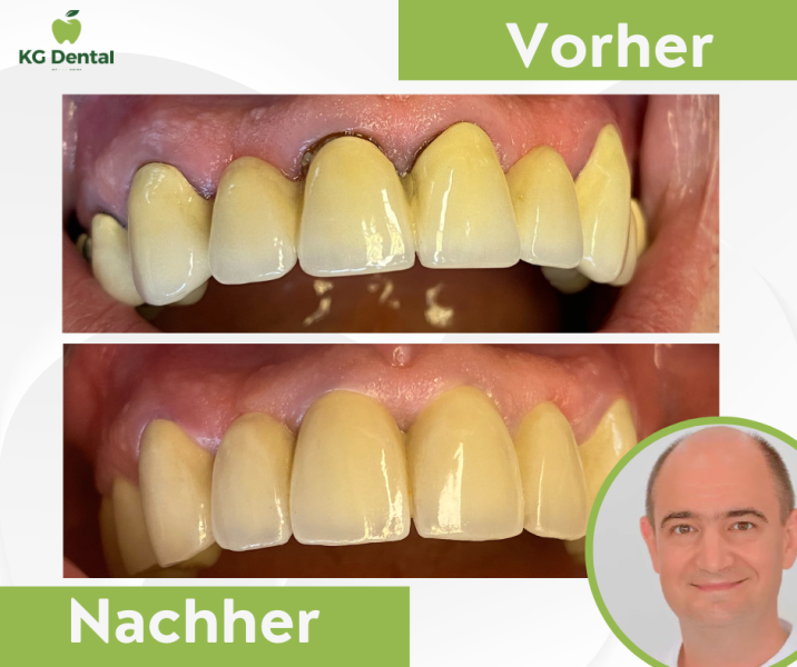 Zahnprothesen vor und nach der Zahnbehandlung mit dem Foto von Dr László Szeder.