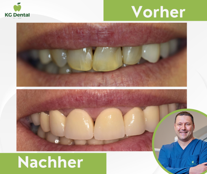 Zahnprothesen vor und nach der Zahnbehandlung mit dem Foto von Dr Zoltán Veres.