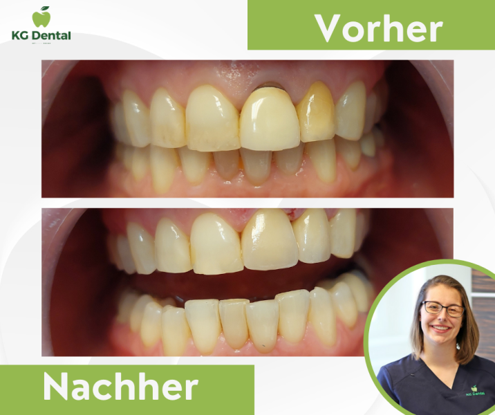 Zahnprothesen vor und nach der Zahnbehandlung mit einem Foto von Dr Mirtil Bertalan.