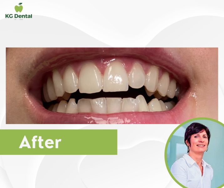 Dentures after oral hygiene treatment with a photo of the dental assistant performing the treatment.