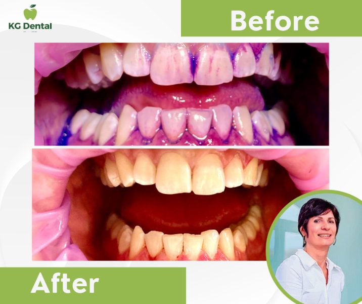 Before and after dental hygiene treatment of dentures with a smiling photo of the dentist performing the procedure.