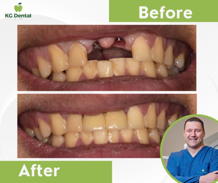 Denture before and after dental restoration with a smiling photo of the dentist performing the procedure.