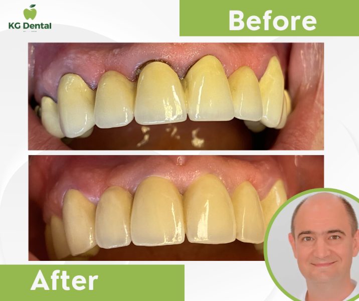 Dentures before and after dental treatment with a smiling photo of the male dentist performing the treatment in the lower right corner.
