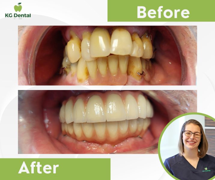 Dentures shown before and after dental treatment with a smiling photo of the dentist performing the procedure.