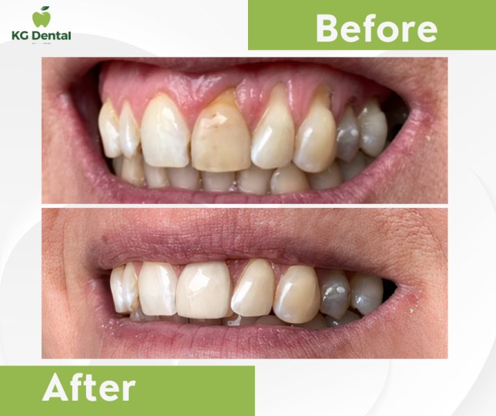 Dentures with gum problems before and after dental treatment.