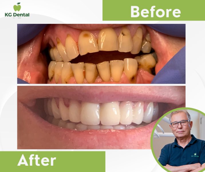 Front view of a set of dentures before and after dental treatment with a photo of the male dentist performing the treatment in the lower right corner of the image.