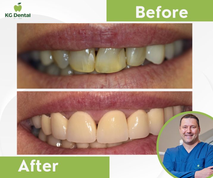 Dentures before and after dental treatment with a photo of the kindly smiling male dentist performing the treatment in the lower right corner of the image.