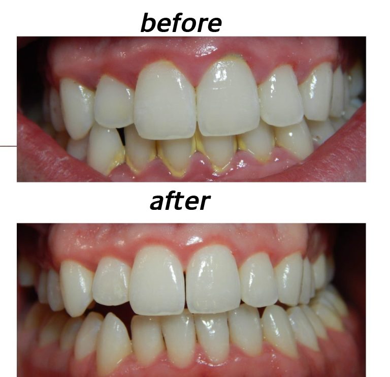Dentures before and after oral hygiene treatment.