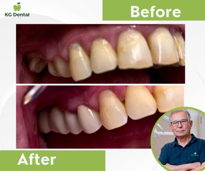 Dentures from the side before and after dental treatment with a photo of the male dentist performing the treatment in the lower right corner of the image.