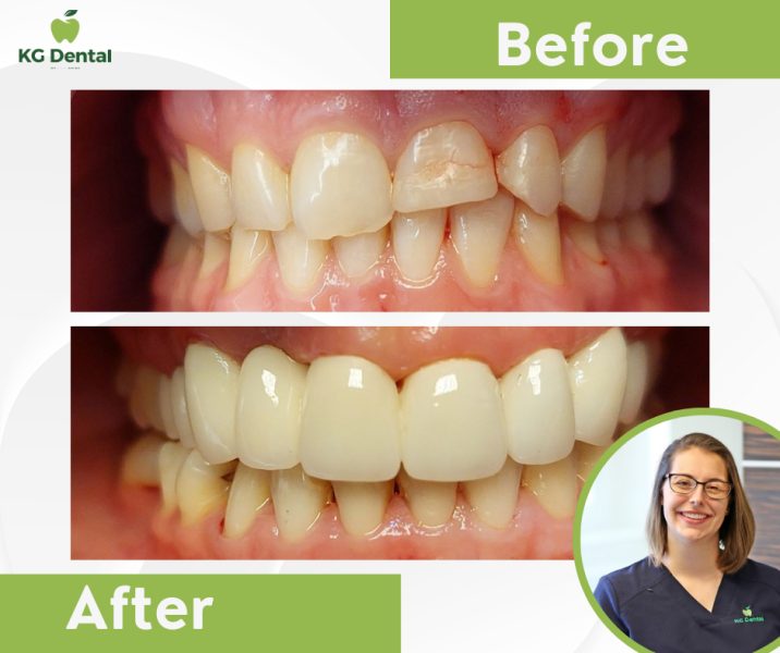 Dentures with a broken tooth before and after dental treatment with the photo of the dentist performing the treatment.