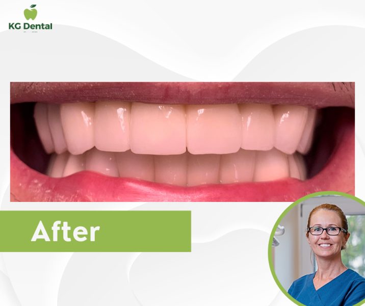 Denture after full zirconia bridge treatment with a photo of the dentist performing the treatment.