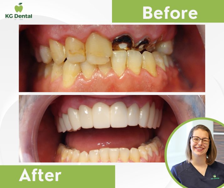 Dentures with removable dentures before and after with a smiling photo of the dentist performing the procedure.